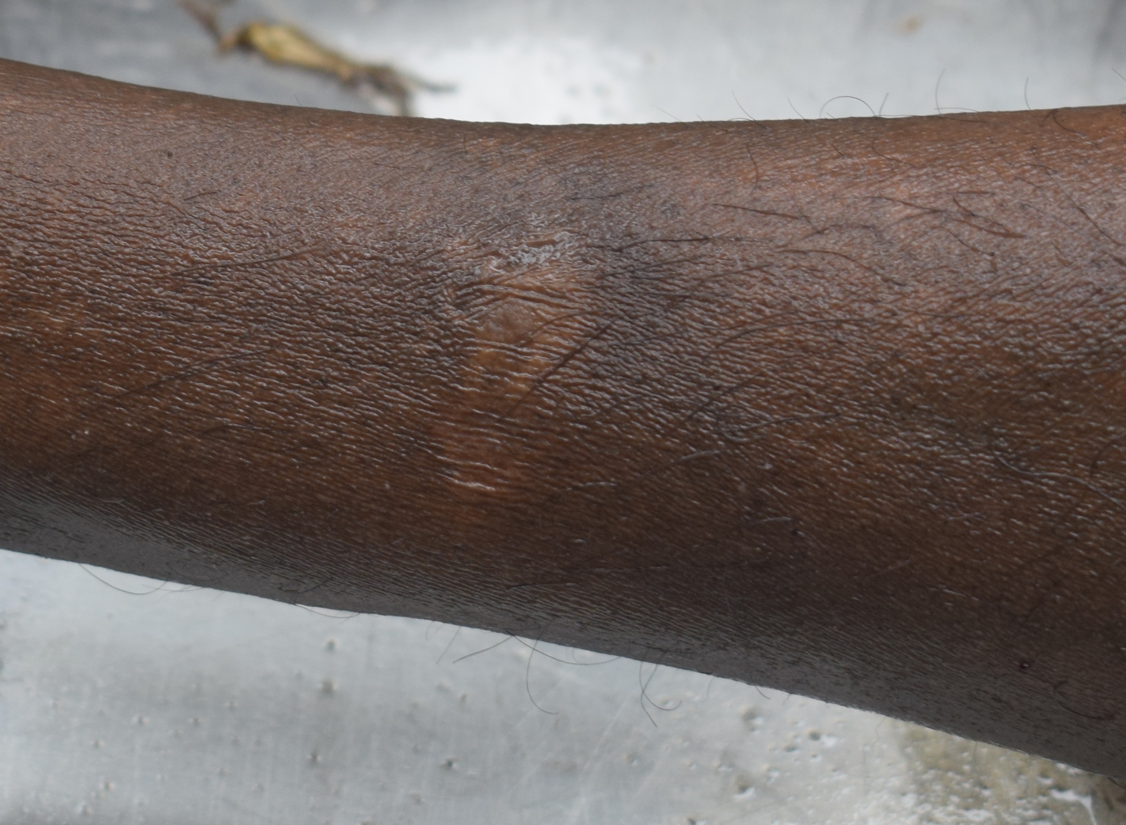 Scar Image